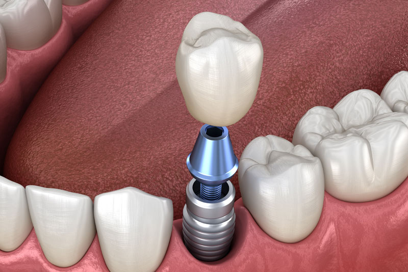 Dental Implant Model In A Patient's Gums
