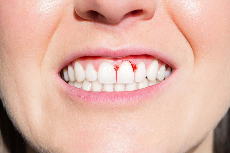 Dental Patient With Gum Disease