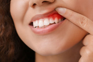 Dental Patient With Gum Disease