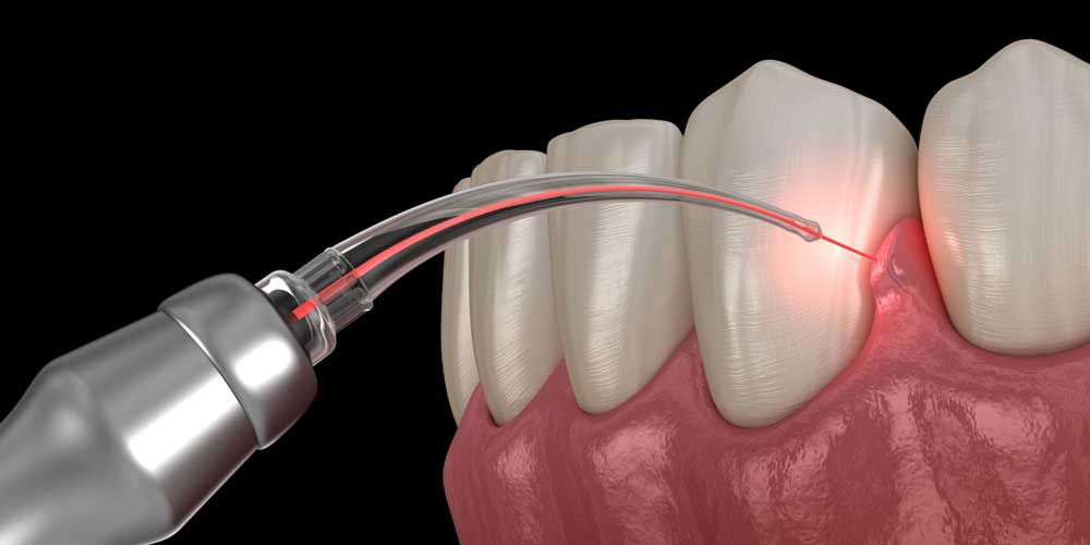 Gum Disease Treatment with LANAP Laser
