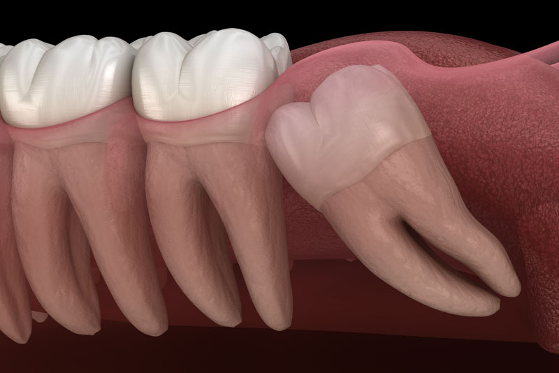 Wisdom Tooth Extraction Graphic