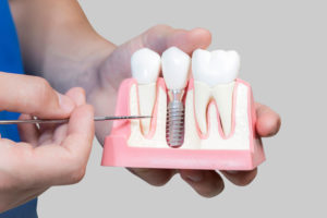 Dental Assistant Showing Off A Dental Implant In A Jawbone Cutaway Model in Palm Harbor, FL